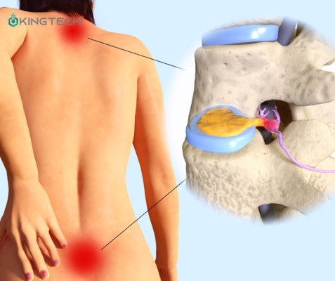 4 lưu ý khi đi bộ để cải thiện thoát vị đĩa đệm