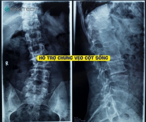 Tư thế cây cầu - Bài tập đơn giản hiệu quả