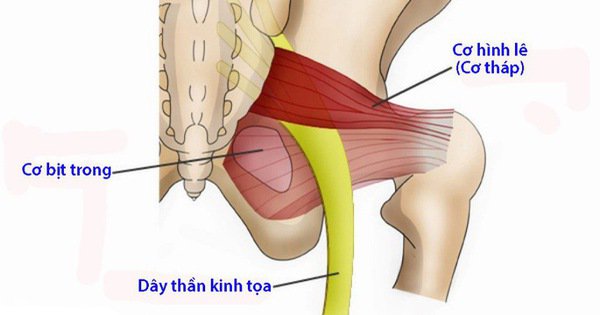 Hội chứng cơ hình lê