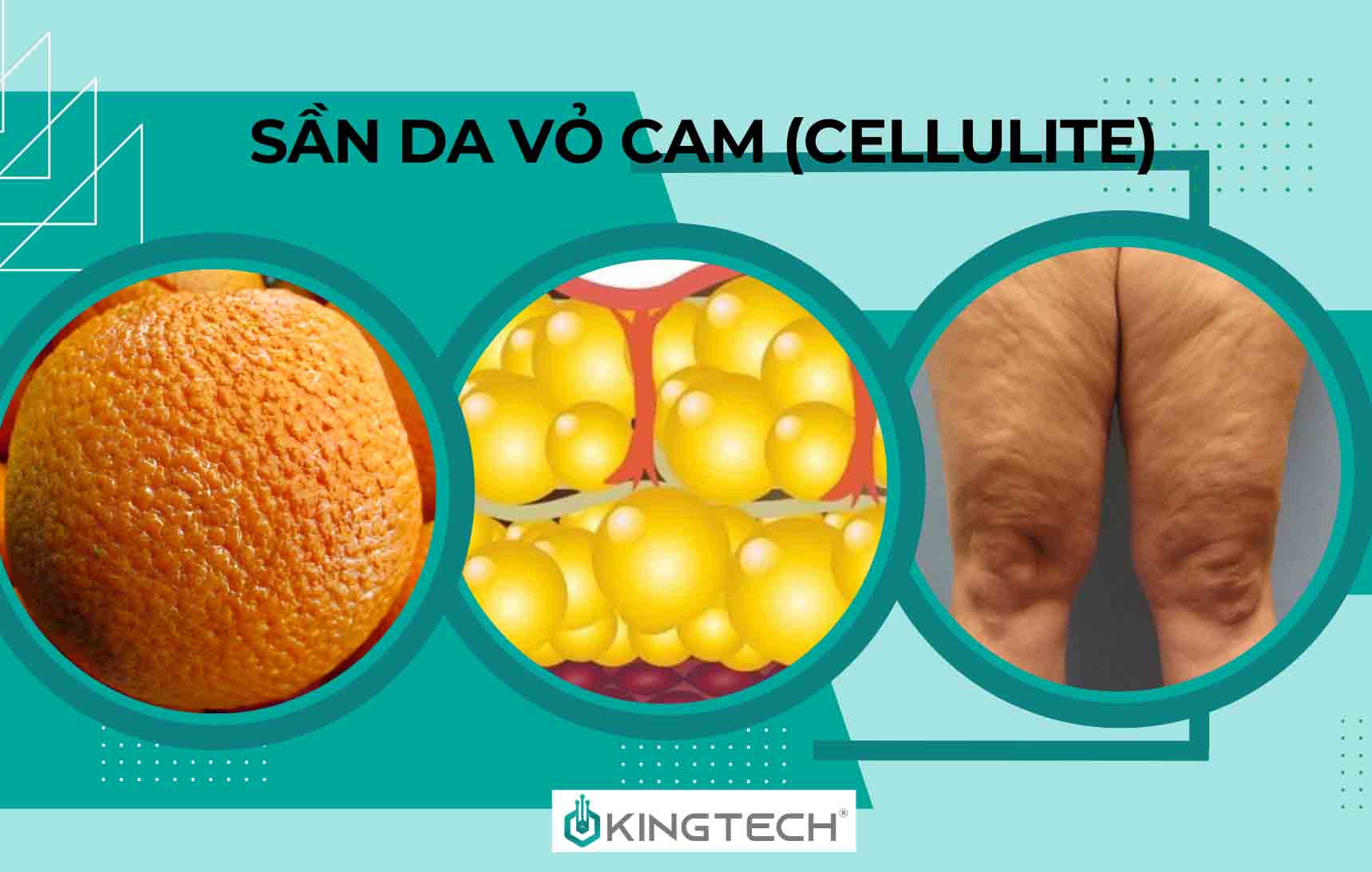 Cải thiện sần da vỏ cam bằng súng massage (Cellulite)