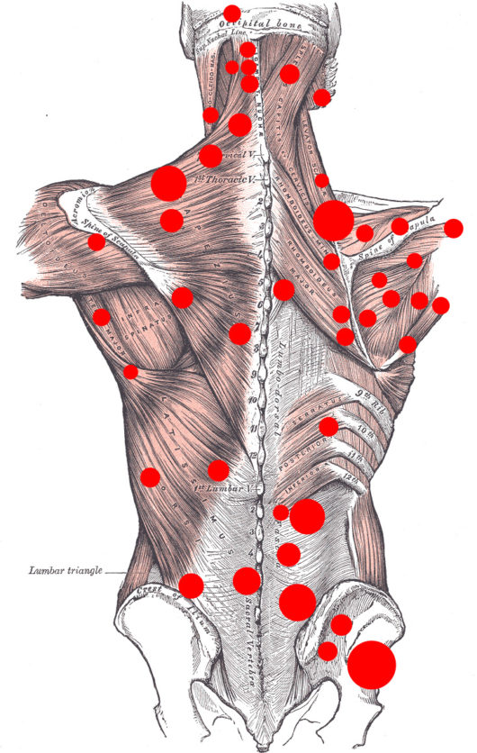 Trigger points