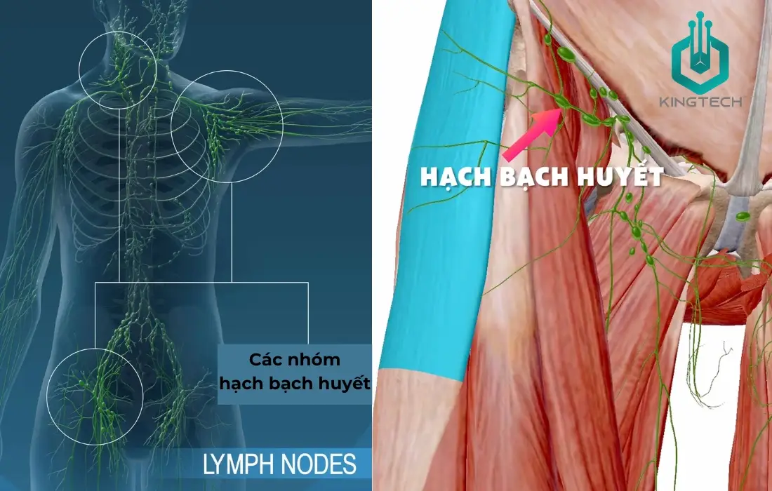 Hạch bạch huyết
