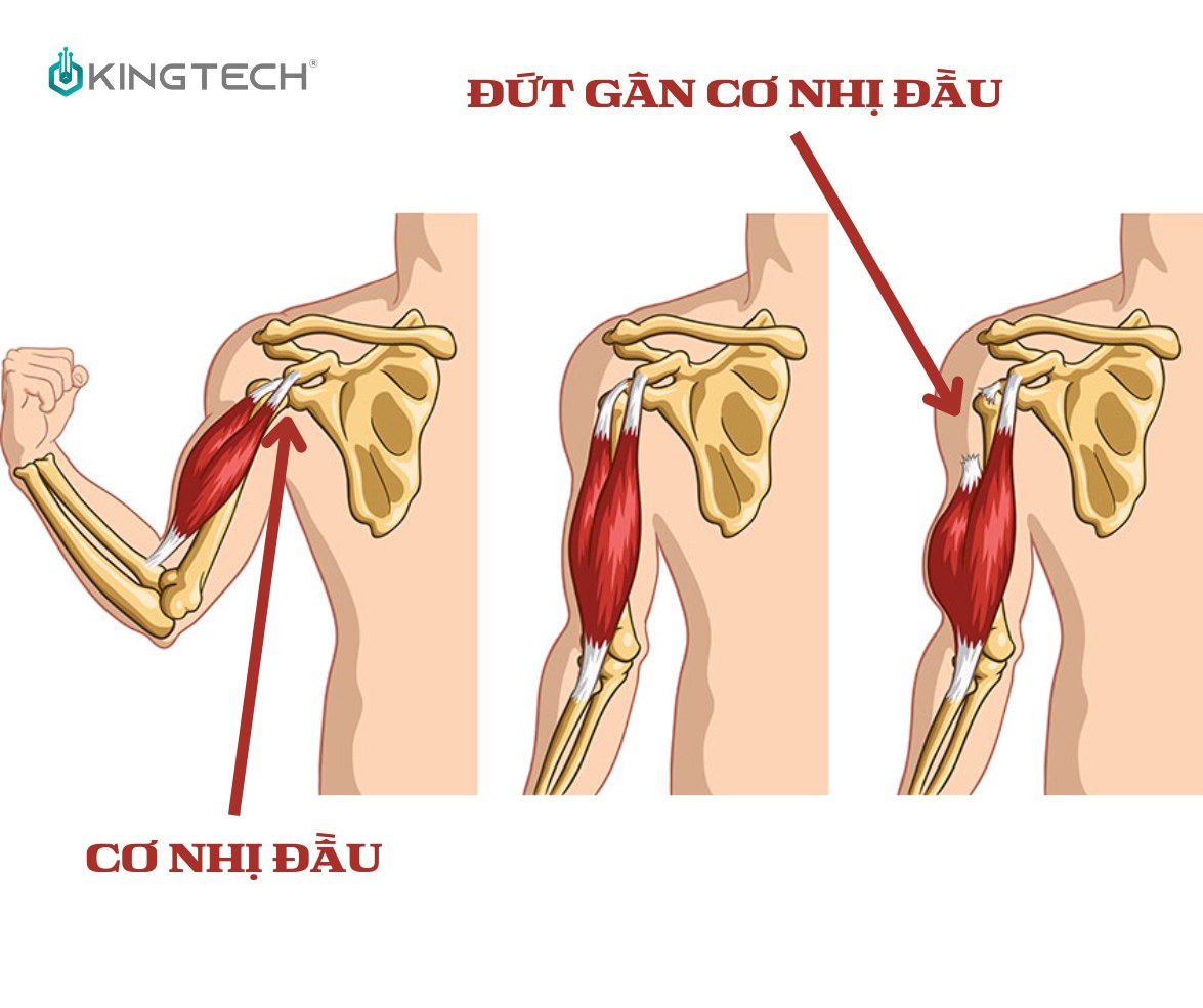 Chấn thương cơ nhị đầu và cách phòng tránh