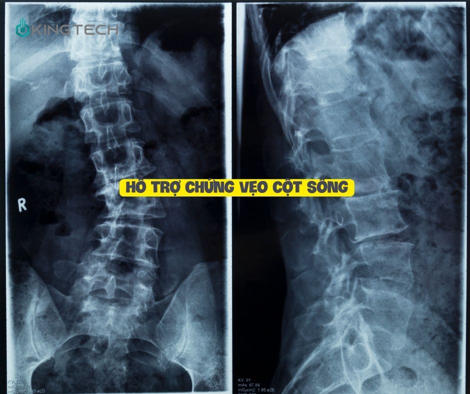 Tư thế cây cầu - Bài tập đơn giản hiệu quả