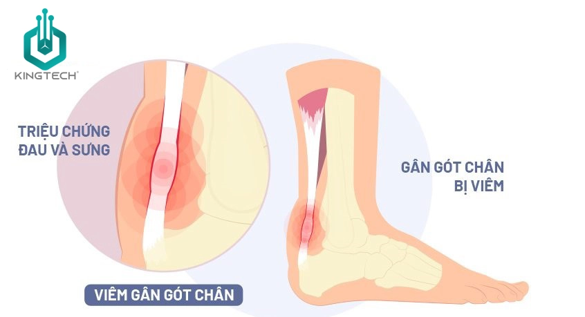 Cách sử dụng súng massage cho viêm gân gót